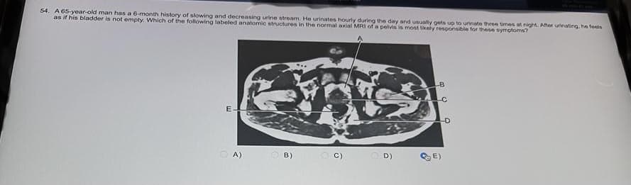 54. A 65-year-old man has a 6-month history of slowing and decreasing urine stream. He urinates hourly during the day and usually gets up to urinate three times at night. After urinating, he feels
as if his bladder is not empty. Which of the following labeled anatomic structures in the normal axial MRI of a pelvis is most likely responsible for these symptoms?
E
A)
B)
C) D)
B
-D
E)