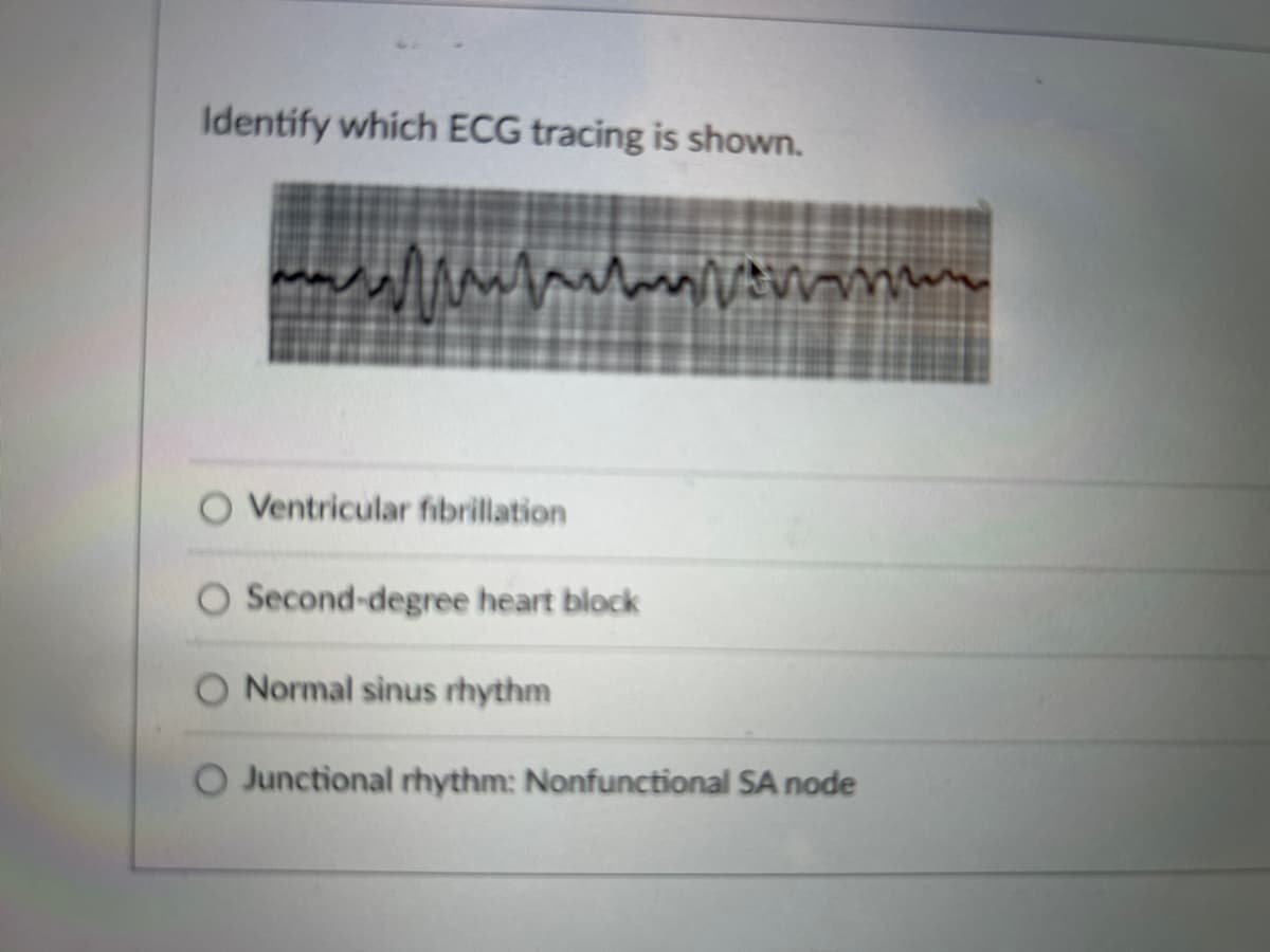 Identify which ECG tracing is shown.
www.om
Ventricular fibrillation
O Second-degree heart block
Normal sinus rhythm
O Junctional rhythm: Nonfunctional SA node