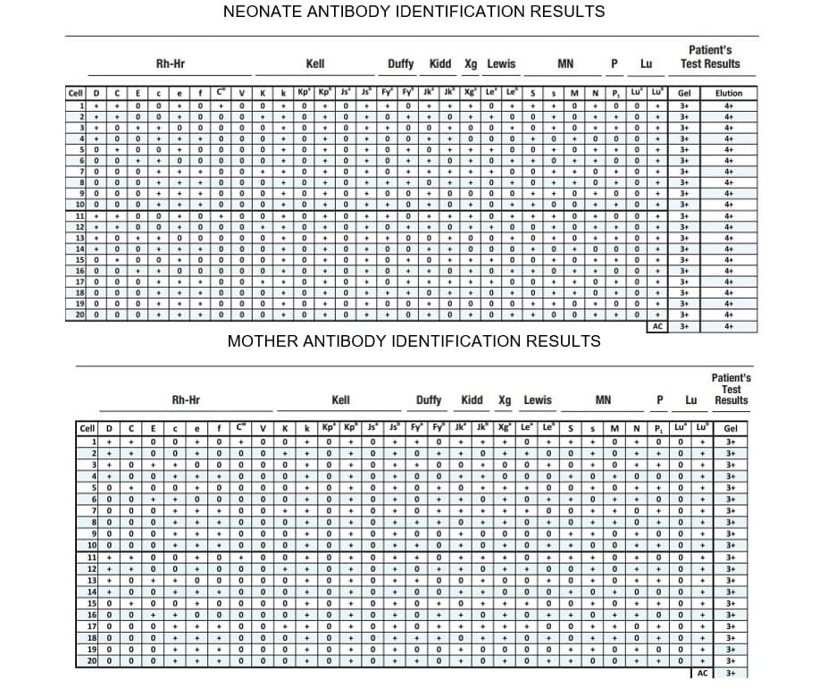 NEONATE ANTIBODY IDENTIFICATION RESULTS
Patient's
Test Results
Rh-Hr
Kell
Duffy Kidd
Xg Lewis
MN
P
Lu
Cell D
f
k
Kp'| Kp"| Js'
Js" | Fy
Fy
Jk'
Jk"
Xg
Le
LeS
P, Lu Lu
Gel
Elution
e
K
M
N
+++0
3+
4+
2 + • O0
3+
4+
3+
4+
4 +
3+
4+
3+
4+
6 0
기 0
8 0
9 0
10 0
11 +
12 +
3+
4+
3+
4+
3+
4+
3+
4+
3+
4+
+
3+
4+
3+
4+
13
14 +
15 0
16 0
17 0
18 0
19 0
20 0
3+
4+
3+
4+
3+
4+
3+
4+
• 0+0
3+
4+
0 + 0.
•00 0
3+
4+
3+
4+
3+
4+
AC
3+
4+
MOTHER ANTIBODY IDENTIFICATION RESULTS
Patient's
P Lu
Test
Results
Rh-Hr
Kell
Duffy
Kidd
Xg
Lewis
MN
efC" v
0+ 0 0+
| 3MN P
Cell
k
Кр
Kp
Js
Js Fy Fy Jk
Jk" | Xg
Le
Le
Lu Lu
Gel
D
K
0+00
1
3+
2
+
3+
+00 00
3+
3+
5
+0+ +0
3+
6.
3+
3+
3+
3+
00+ + 0
+0+
10
3+
11
3+
12
3+
13
3+
14
3+
15
+
+
3+
16
+
+
3+
17
+
3+
+
18
+
+
+
+
3+
19
3+
20
3+
AC
3+
*
LLL LLLI
elelelele
++0+
elelelele
3000이이이이이이이이이이o
+O+++o
lelelLelelel
+le
elelel+leeelelelelelelelele JJde
lele
alele
el+
lele
++
이0+|+|+ | +|0+
+++
ola
++lo+lol++le
elalelel++++o0
+lelelelolelelalel
+olo++++lels
olel+
olo
lelele
ele
ele
ole
elalelelelel+ooo
..I.I
elelelelelo
elelelelelelelle
>lelelelelelelelelele
lelelo
lelelelele
이이0이이이
ele
elelelelele
alc
lole
ole
elelelo
+0oo oolololole
elelelele
ole
+leleloleleleleles
lelelele
elelele
+++
elelel+le
ol++
ele
+O++++
+lel+l+
| +|0101+ |0이00。
