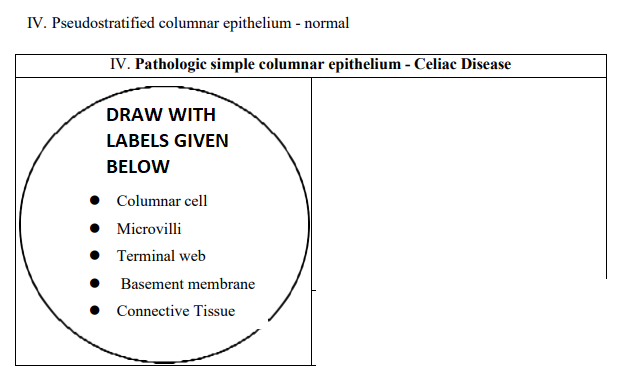 IV. Pseudostratified columnar epithelium - normal
IV. Pathologic simple columnar epithelium - Celiac Disease
DRAW WITH
LABELS GIVEN
BELOW
● Columnar cell
Microvilli
● Terminal web
Basement membrane
Connective Tissue