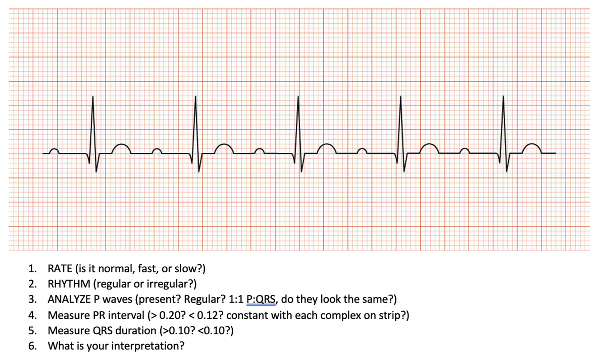 hathath
1. RATE (is it normal, fast, or slow?)
2.
RHYTHM (regular or irregular?)
3. ANALYZE P waves (present? Regular? 1:1 P:QRS, do they look the same?)
4. Measure PR interval (>0.20? <0.12? constant with each complex on strip?)
5. Measure QRS duration (>0.10? <0.10?)
6. What is your interpretation?