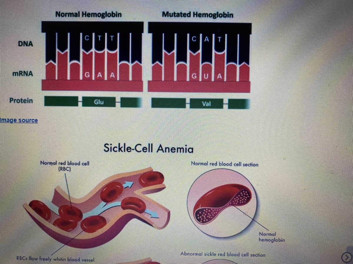 Normal Hemoglobin
Mutated Hemoglobin
T
T
C
A
T
DNA
MRNA
GU
Protein
Glu
Val
Image source
Sickle-Cell Anemia
Normal red blood cell
(RBC)
Normal red blood cell section
Normal
hemoglobin
Abnormal sickle red blood cell section
RBCS flow freely whitin blood vessel
