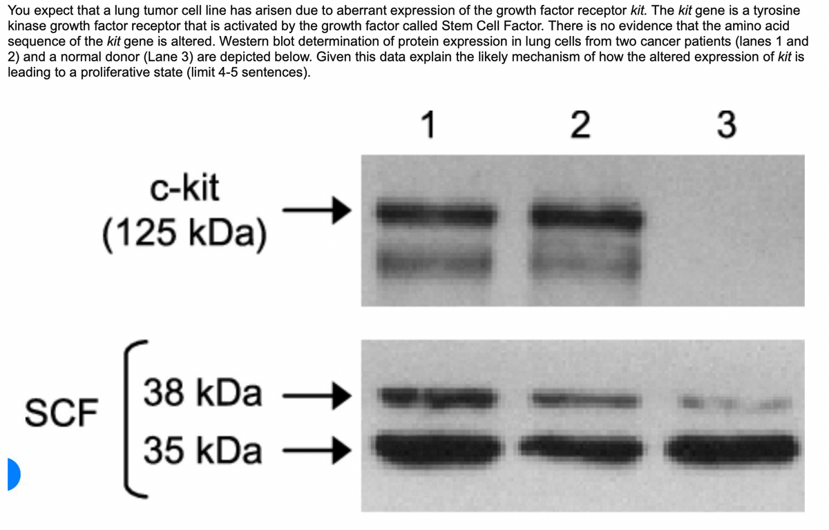 You expect that a lung tumor cell line has arisen due to aberrant expression of the growth factor receptor kit. The kit gene is a tyrosine
kinase growth factor receptor that is activated by the growth factor called Stem Cell Factor. There is no evidence that the amino acid
sequence of the kit gene is altered. Western blot determination of protein expression in lung cells from two cancer patients (lanes 1 and
2) and a normal donor (Lane 3) are depicted below. Given this data explain the likely mechanism of how the altered expression of kit is
leading to a proliferative state (limit 4-5 sentences).
1
2
3
SCF
▶
c-kit
(125 kDa)
38 kDa
35 kDa
=