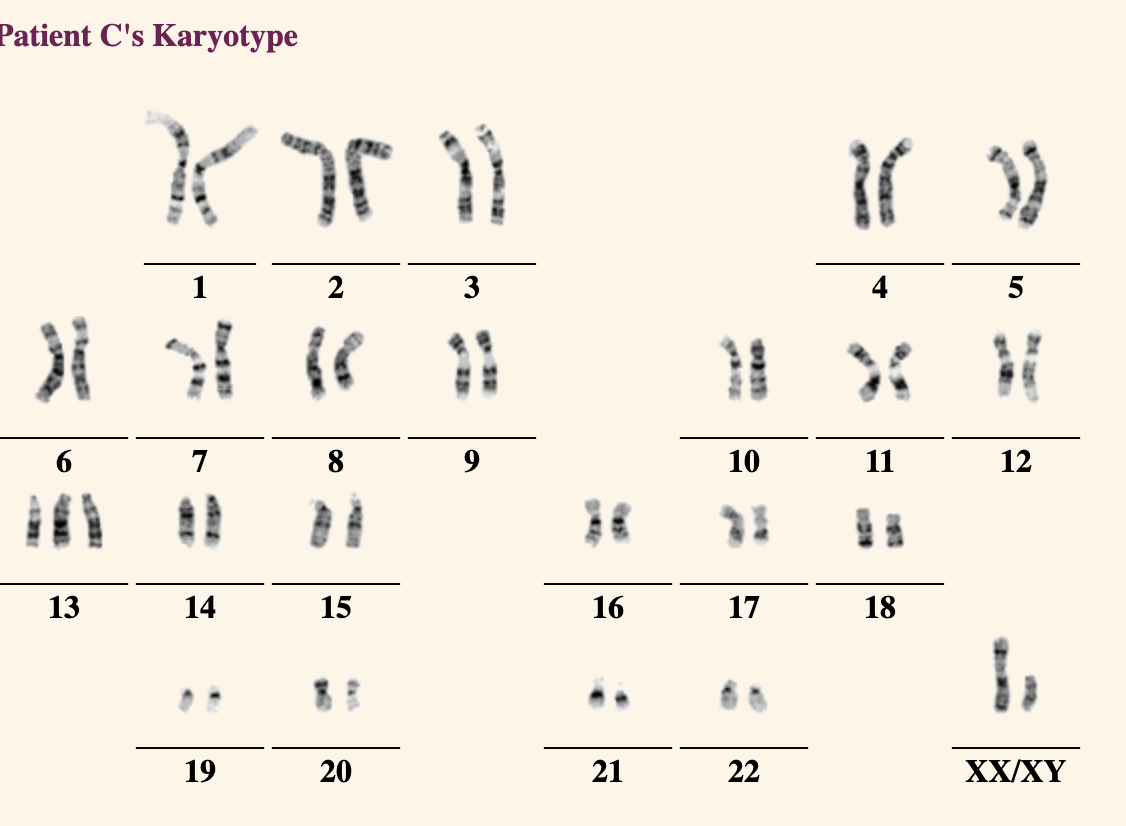 Patient C's Karyotype
13
** การ
1
7
14
19
2
8
15
20
3
11
9
16
21
10
17
22
4
11
18
5
12
XX/XY