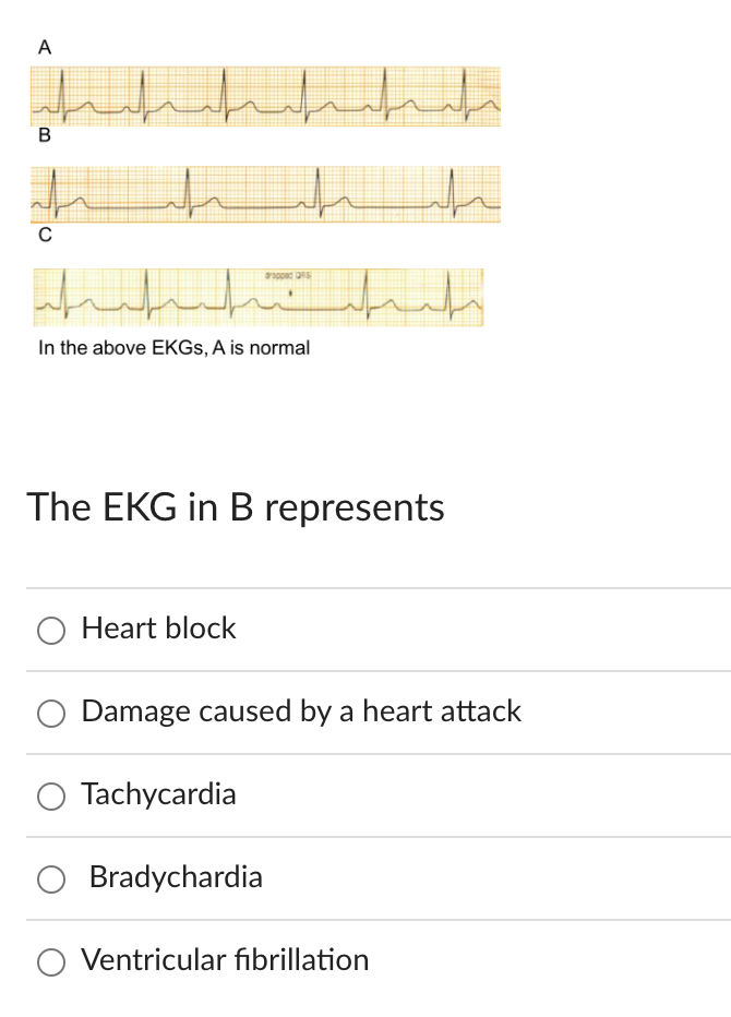 A
B
C
In the above EKGs, A is normal
O Heart block
dropped
The EKG in B represents
O Tachycardia
Bradychardia
t
Damage caused by a heart attack
ملت
Ventricular fibrillation