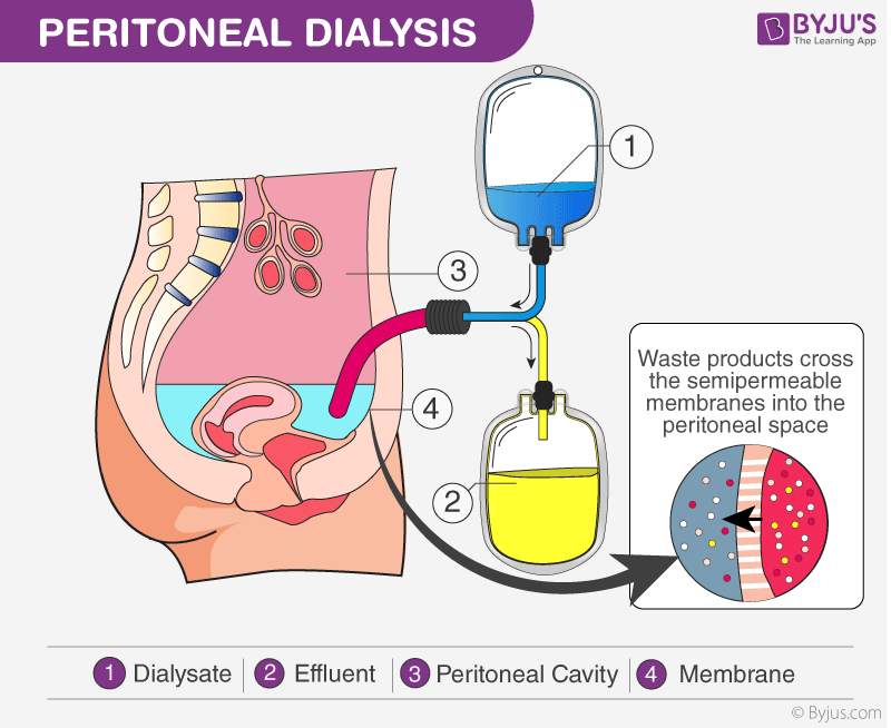 PERITONEAL DIALYSIS
4
3
(2)
(1)
BBYJU'S
The Learning App
Waste products cross
the semipermeable
membranes into the
peritoneal space
1 Dialysate 2 Effluent 3 Peritoneal Cavity 4 Membrane
Byjus.com