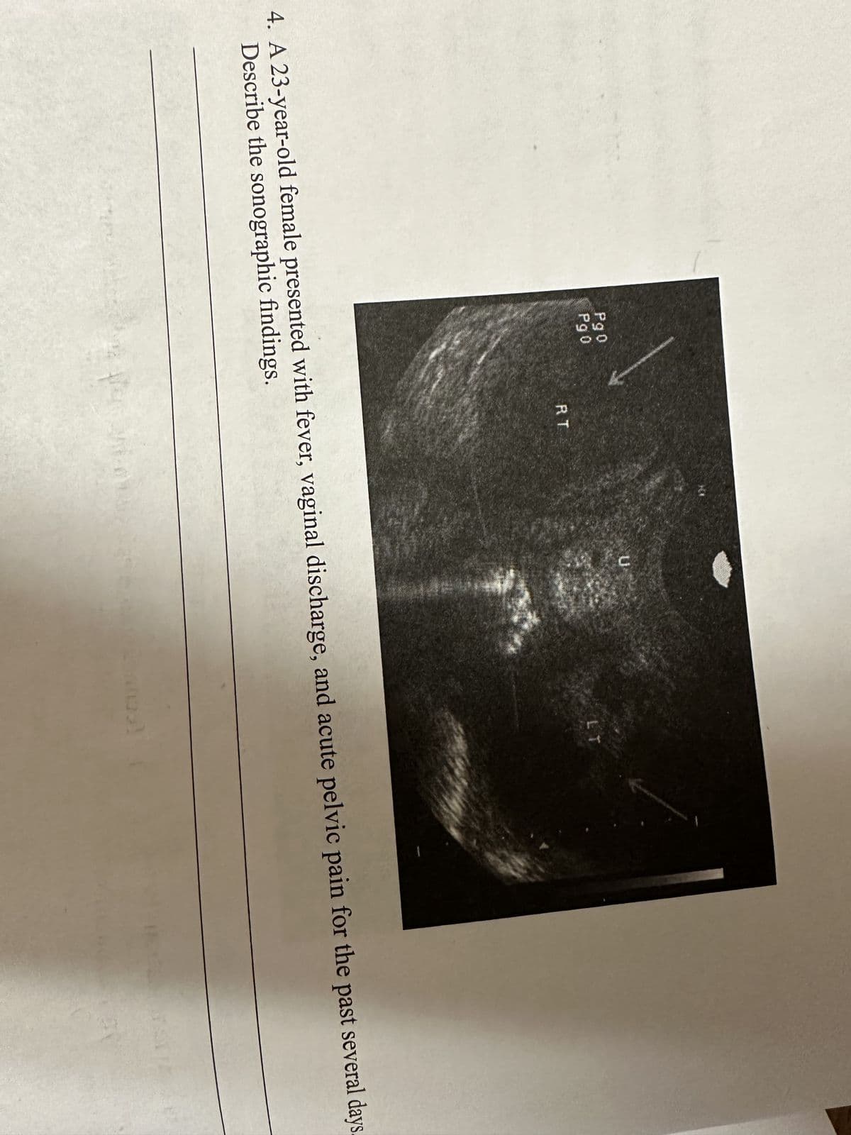 Pg0
Pg0
LT
4. A 23-year-old female presented with fever, vaginal discharge, and acute pelvic pain for the past several days.
Describe the sonographic findings.
a fen
ter vin