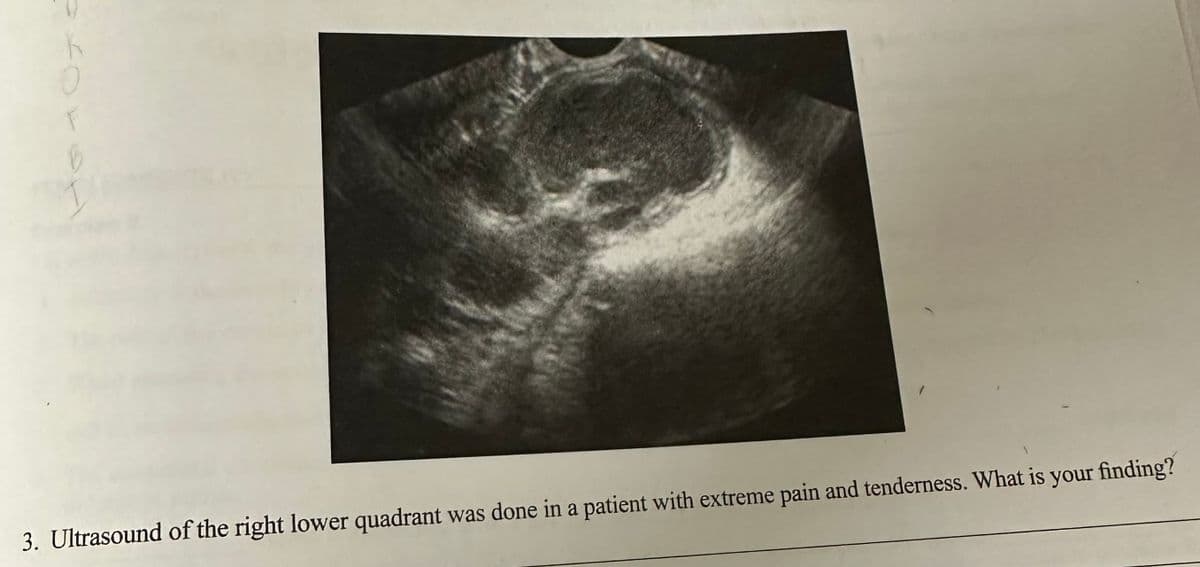 K
0
B
3. Ultrasound of the right lower quadrant was done in a patient with extreme pain and tenderness. What is your finding?