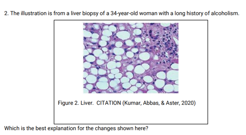 2. The illustration is from a liver biopsy of a 34-year-old woman with a long history of alcoholism.
Figure 2. Liver. CITATION (Kumar, Abbas, & Aster, 2020)
Which is the best explanation for the changes shown here?
