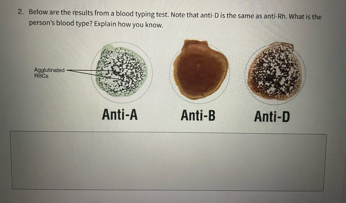 2. Below are the results from a blood typing test. Note that anti-D is the same as anti-Rh. What is the
person's blood type? Explain how you know.
Agglutinated
RBCs
Anti-A
Anti-B
Anti-D