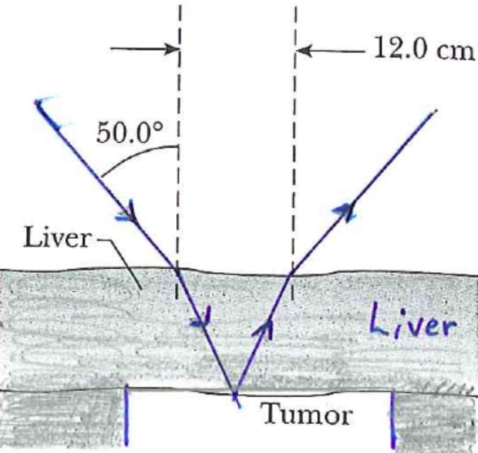 Liver
50.0°
Tumor
12.0 cm
Liver