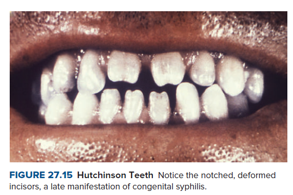 FIGURE 27.15 Hutchinson Teeth Notice the notched, deformed
incisors, a late manifestation of congenital syphilis.
