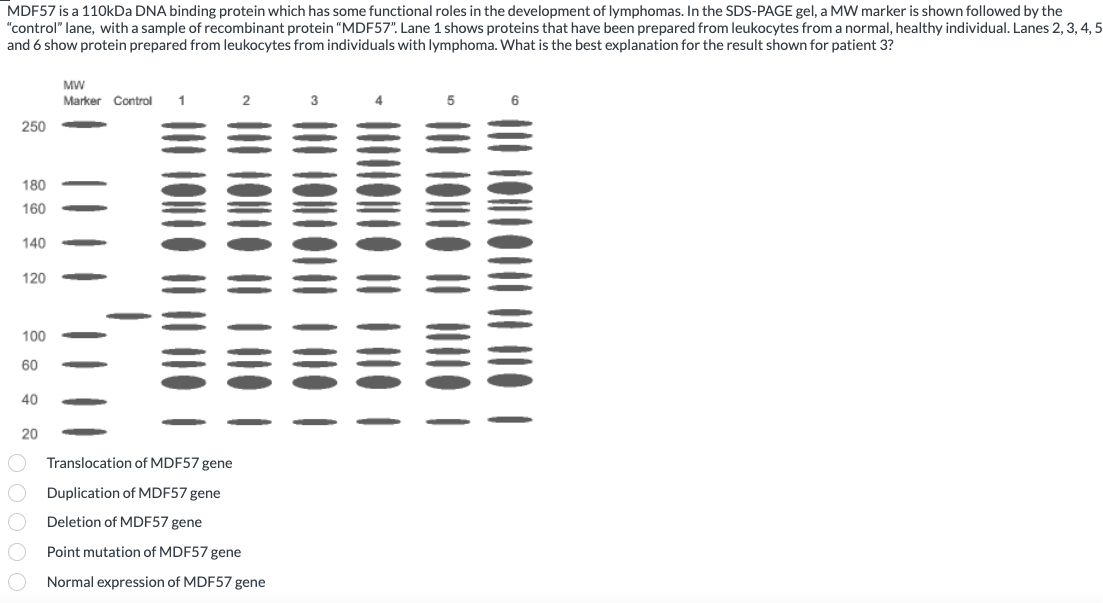 MDF57 is a 110kDa DNA binding protein which has some functional roles in the development of lymphomas. In the SDS-PAGE gel, a MW marker is shown followed by the
"control" lane, with a sample of recombinant protein "MDF57". Lane 1 shows proteins that have been prepared from leukocytes from a normal, healthy individual. Lanes 2, 3, 4, 5
and 6 show protein prepared from leukocytes from individuals with lymphoma. What is the best explanation for the result shown for patient 3?
250
180
160
140
120
100
60
40
20
MW
Marker Control
1 2
Translocatio
F57 gene
Duplication of MDF57 gene
Deletion of MDF57 gene
Point mutation of MDF57 gene
Normal expression of MDF57 gene
5
||||||||||||
|||||||||||
6