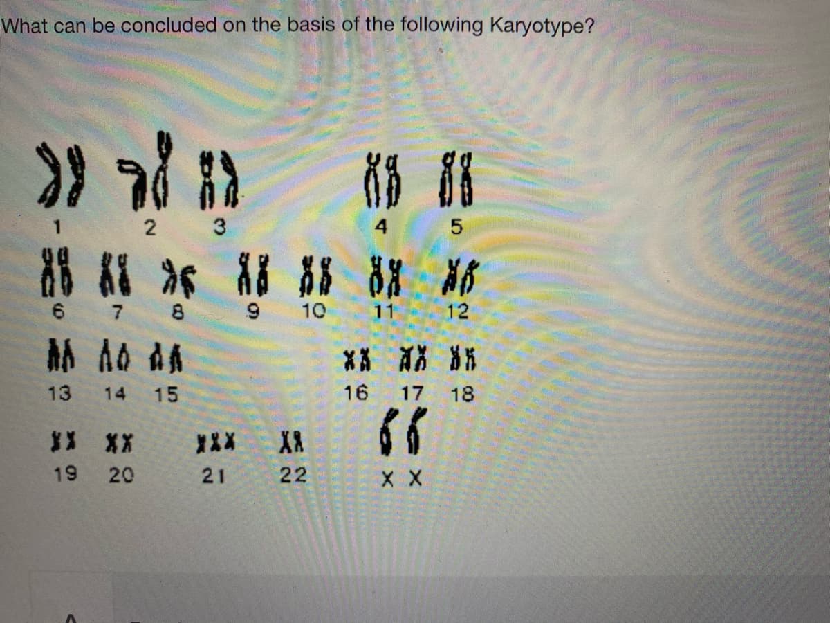 What can be concluded on the basis of the following Karyotype?
2 3
4 5
6 7
8
10
11 12
** X 8%
13
14
15
16
17 18
X* **
21
19 20
22
X X
