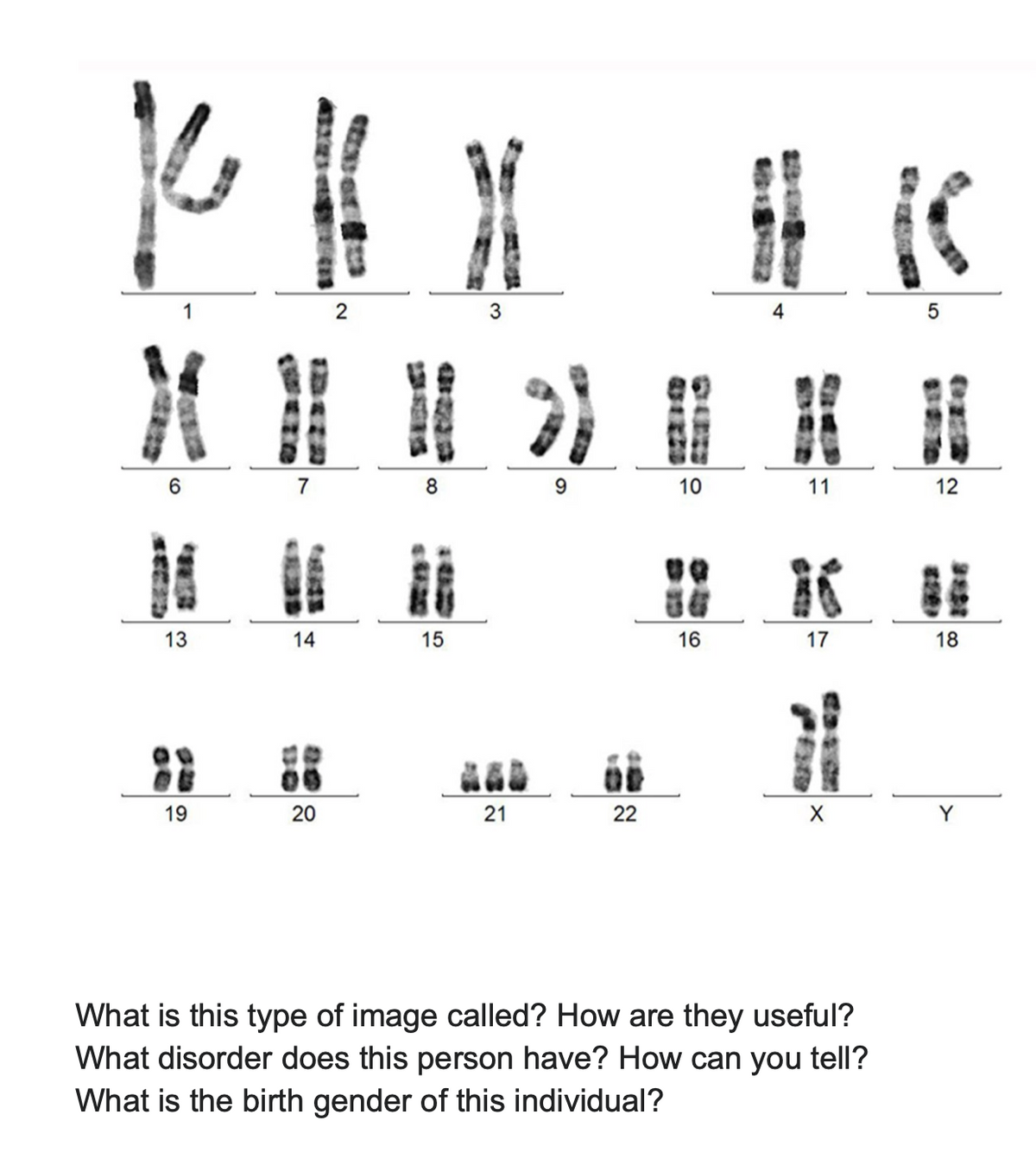 1
6
13
19
| }H_IC
K
2
7
14
20
8
15
3
21
22
10
16
H
11
17
X
What is this type of image called? How are they useful?
What disorder does this person have? How can you tell?
What is the birth gender of this individual?
5
12
18
Y