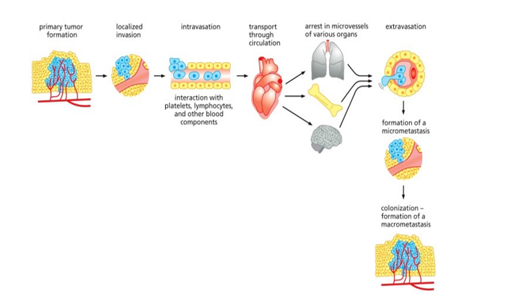 primary tumor
formation
transport
through
circulation
arrest in microvessels
localized
invasion
intravasation
extravasation
of various organs
interaction with
platelets, lymphocytes,
and other blood
formation of a
micrometastasis
components
colonization -
formation of a
macrometastasis
