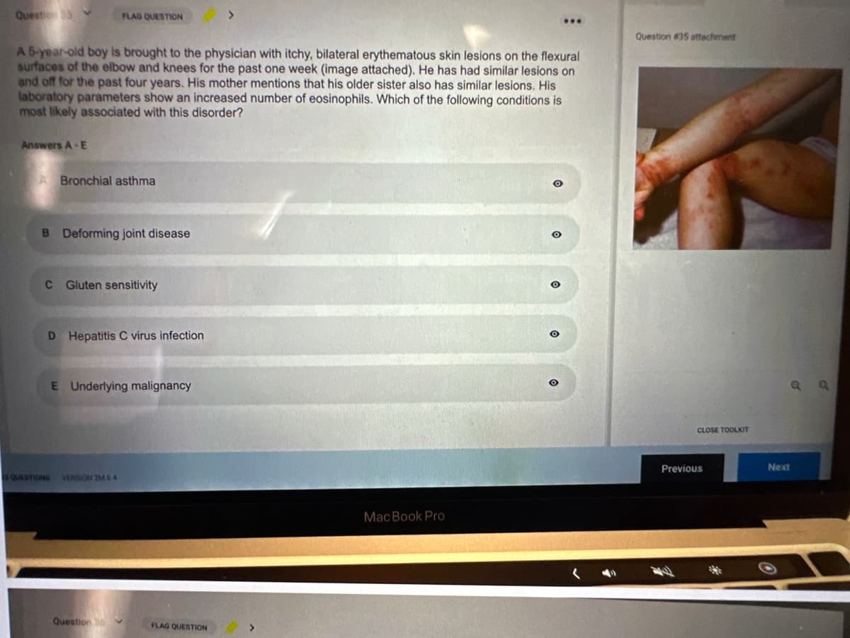 Question ✓
Answers A-E
FLAG QUESTION
A 5-year-old boy is brought to the physician with itchy, bilateral erythematous skin lesions on the flexural
surfaces of the elbow and knees for the past one week (image attached). He has had similar lesions on
and off for the past four years. His mother mentions that his older sister also has similar lesions. His
laboratory parameters show an increased number of eosinophils. Which of the following conditions is
most likely associated with this disorder?
Bronchial asthma
B Deforming joint disease
C Gluten sensitivity
D Hepatitis C virus infection
E Underlying malignancy
QUESTIONS VERSION 2M64
Question 30
>
FLAG QUESTION
...
MacBook Pro
Question #35 attachment
CLOSE TOOLKIT
Previous
a a
Next