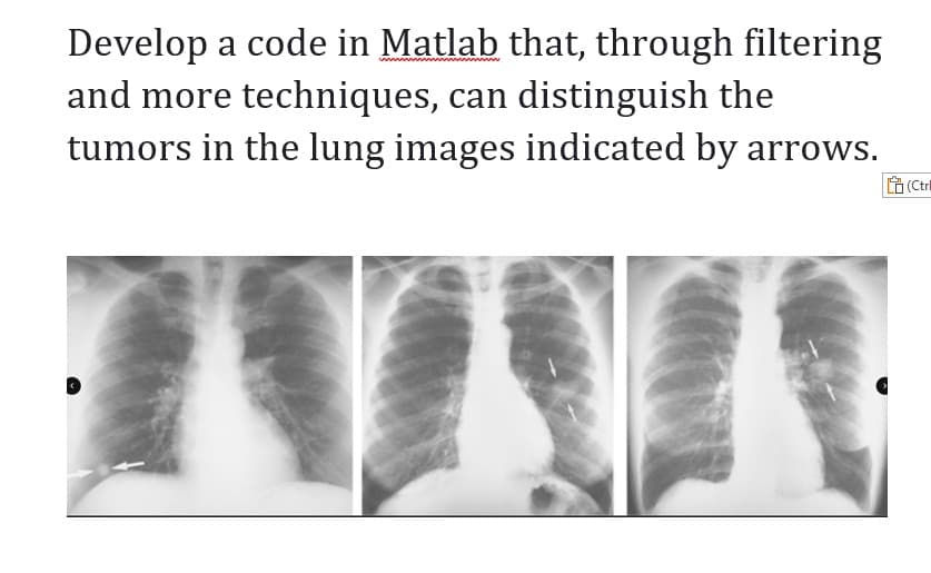 Develop a code in Matlab that, through filtering
and more techniques, can distinguish the
tumors in the lung images indicated by arrows.
(Ctr