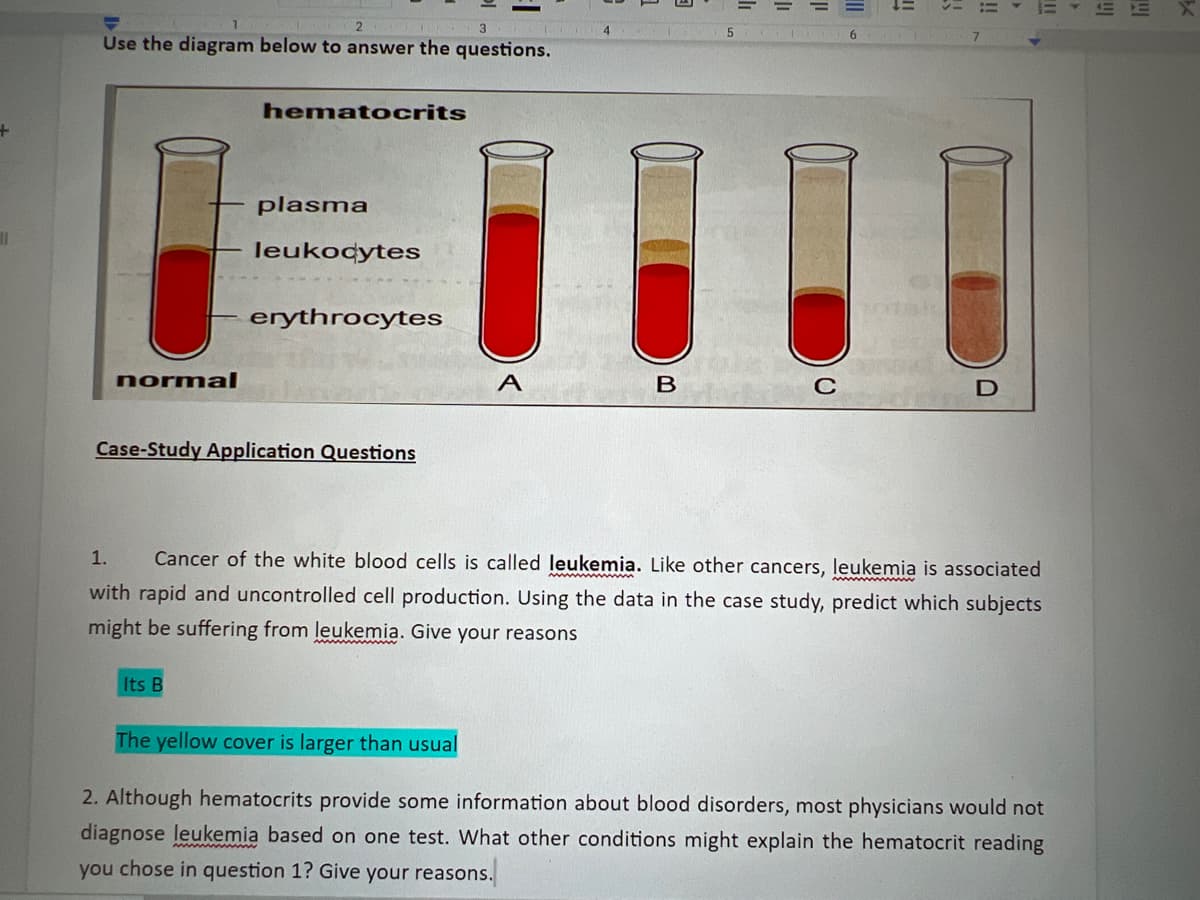 +
11
!!
6
31
ii
111
2
3
4
5
Use the diagram below to answer the questions.
hematocrits
plasma
leukocytes
I
erythrocytes
normal
A
B
C
D
Case-Study Application Questions
1. Cancer of the white blood cells is called leukemia. Like other cancers, leukemia is associated
with rapid and uncontrolled cell production. Using the data in the case study, predict which subjects
might be suffering from leukemia. Give your reasons
Its B
The yellow cover is larger than usual
2. Although hematocrits provide some information about blood disorders, most physicians would not
diagnose leukemia based on one test. What other conditions might explain the hematocrit reading
you chose in question 1? Give your reasons.
!!!
WI
X