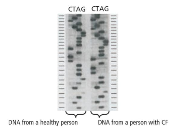CTAG CTAG
DNA from a healthy person
DNA from a person with CF
III| |||I
