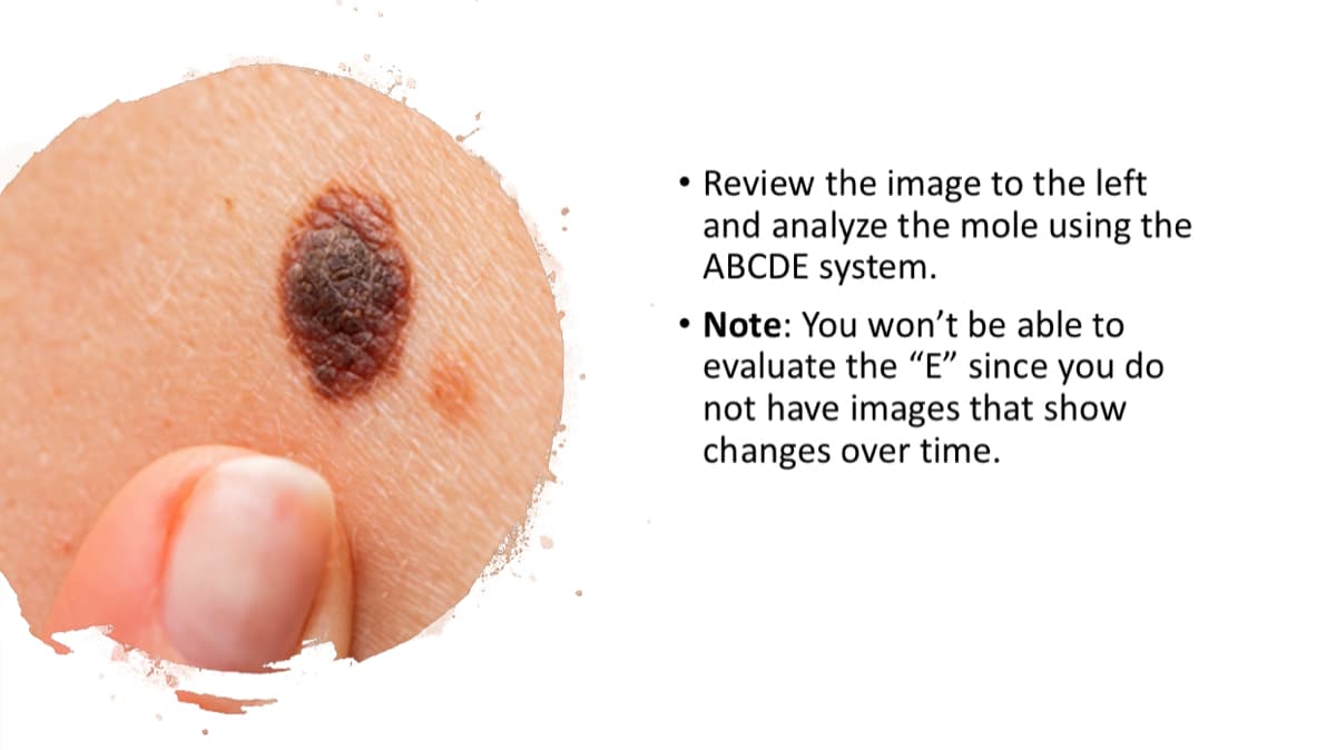 Review the image to the left
and analyze the mole using the
ABCDE system.
• Note: You won't be able to
evaluate the "E" since you do
not have images that show
changes over time.
