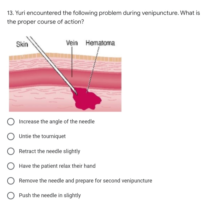 13. Yuri encountered the following problem during venipuncture. What is
the proper course of action?
Skin
Vein Hematoma
Increase the angle of the needle
Untie the tourniquet
Retract the needle slightly
Have the patient relax their hand
Remove the needle and prepare for second venipuncture
Push the needle in slightly
