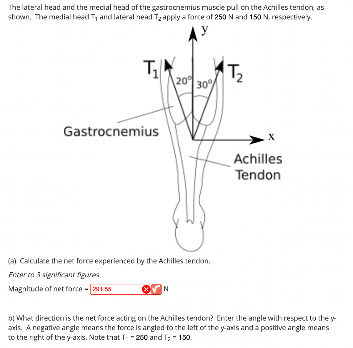 The lateral head and the medial head of the gastrocnemius muscle pull on the Achilles tendon, as
shown. The medial head T₁ and lateral head T₂ apply a force of 250 N and 150 N, respectively.
y
T₁
Gastrocnemius
20%
X N
30°
(a) Calculate the net force experienced by the Achilles tendon.
Enter to 3 significant figures
Magnitude of net force = 291.55
T₂
X
Achilles
Tendon
b) What direction is the net force acting on the Achilles tendon? Enter the angle with respect to the y-
axis. A negative angle means the force is angled to the left of the y-axis and a positive angle means
to the right of the y-axis. Note that T₁ = 250 and T₂ = 150.