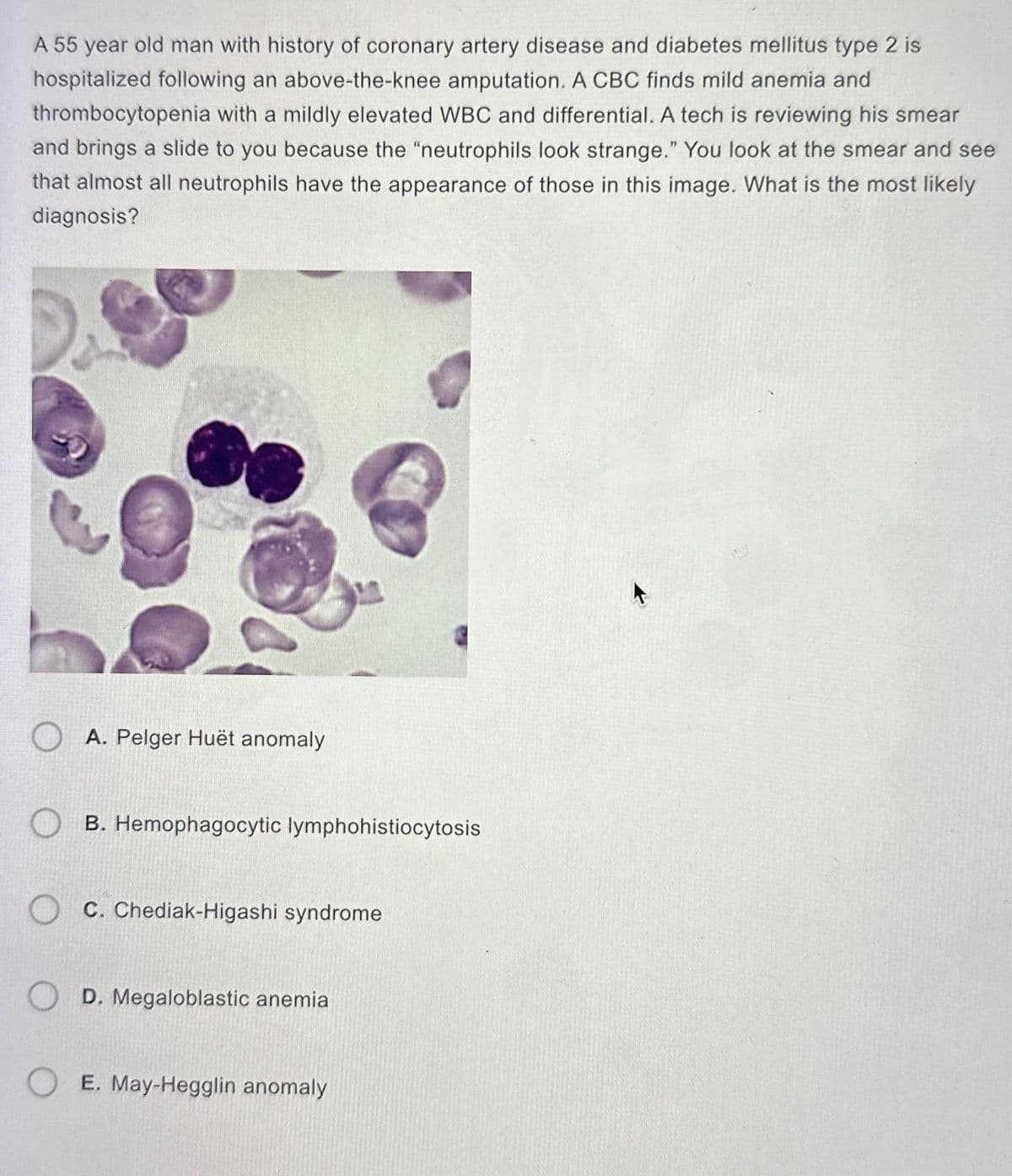 A 55 year old man with history of coronary artery disease and diabetes mellitus type 2 is
hospitalized following an above-the-knee amputation. A CBC finds mild anemia and
thrombocytopenia with a mildly elevated WBC and differential. A tech is reviewing his smear
and brings a slide to you because the "neutrophils look strange." You look at the smear and see
that almost all neutrophils have the appearance of those in this image. What is the most likely
diagnosis?
A. Pelger Huët anomaly
B. Hemophagocytic lymphohistiocytosis
C. Chediak-Higashi syndrome
OD. Megaloblastic anemia
OE. May-Hegglin anomaly