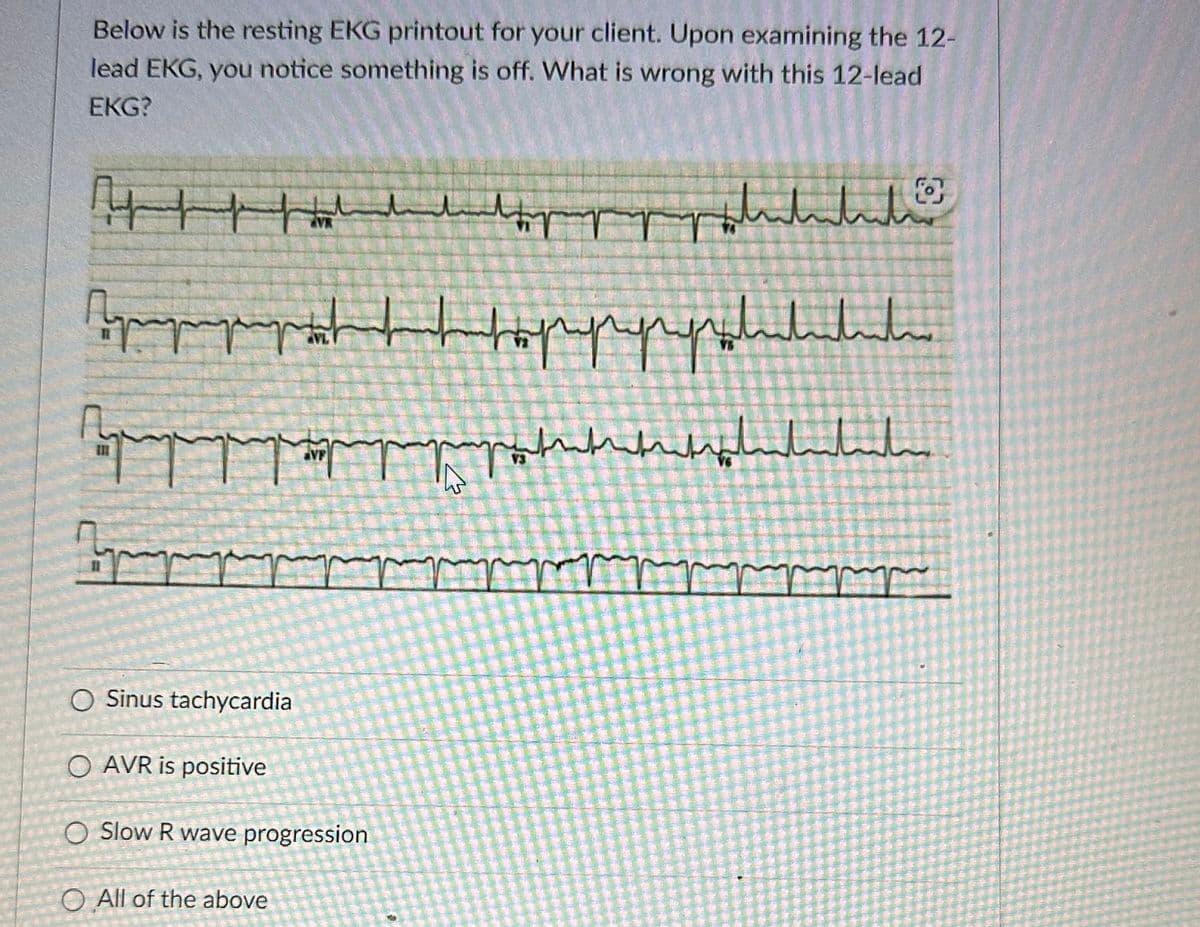 Below is the resting EKG printout for your client. Upon examining the 12-
lead EKG, you notice something is off. What is wrong with this 12-lead
EKG?
r مسلسل مسلسله
H|| | |
Прогр
pppppropropahahahaha
चलत
Прис
O Sinus tachycardia
O AVR is positive
AVF
O Slow R wave progression
O All of the above
بالسلسلة
4
грилл
O
سلسلسليل
ملم
r