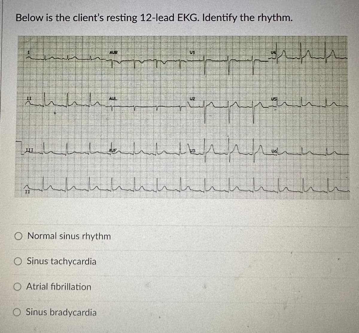 Below is the client's resting 12-lead EKG. Identify the rhythm.
سلسلسلة
بعد به برند
مالية التناسليط السياسيات
الالالالليالي المسلسلسلة
HI
O Normal sinus rhythm.
O Sinus tachycardial
O Atrial fibrillation
مانده
O Sinus bradycardia
مله