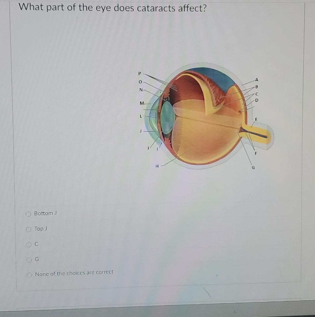 What part of the eye does cataracts affect?
Bottom J
Top J
OC
None of the choices are correct.
P
0
N-
M
H
D