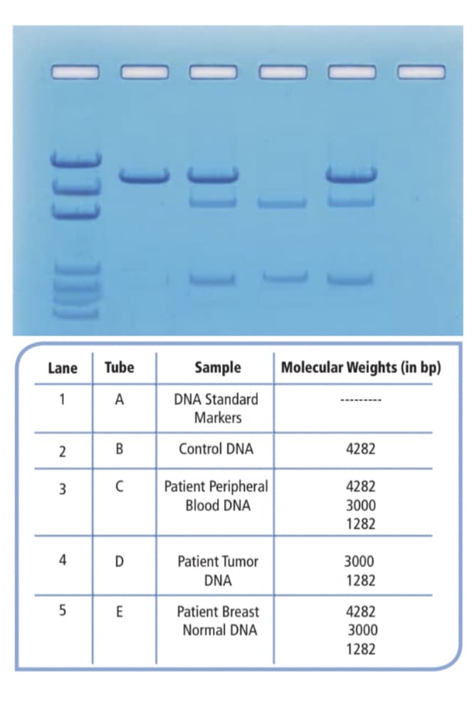 Lane
Tube
Sample
Molecular Weights (in bp)
1
A
DNA Standard
Markers
2
В
Control DNA
4282
Patient Peripheral
4282
Blood DNA
3000
1282
4
D
Patient Tumor
3000
DNA
1282
E
Patient Breast
4282
Normal DNA
3000
1282
]]] )
