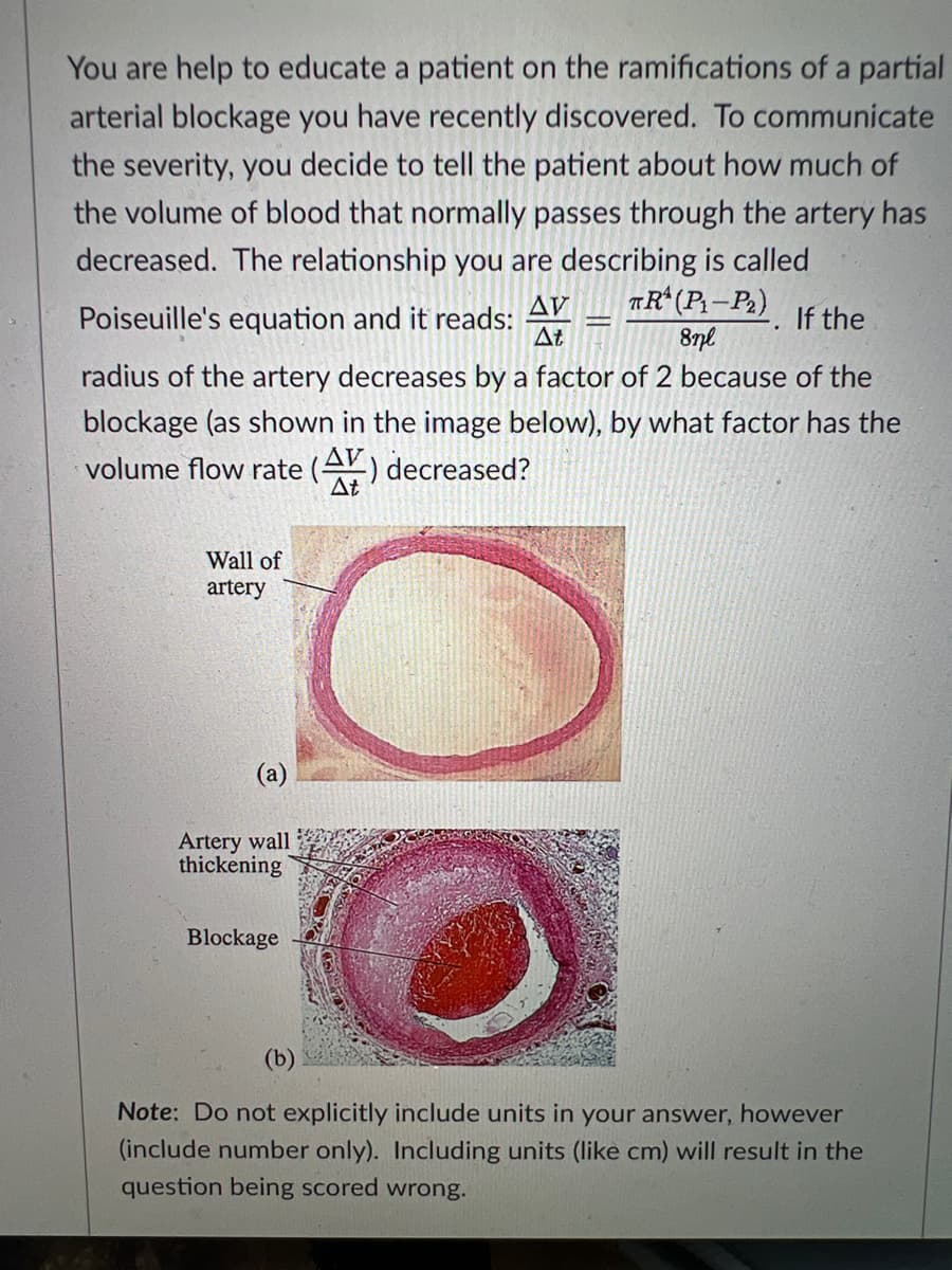 You are help to educate a patient on the ramifications of a partial
arterial blockage you have recently discovered. To communicate
the severity, you decide to tell the patient about how much of
the volume of blood that normally passes through the artery has
decreased. The relationship you are describing is called
AV
Poiseuille's equation and it reads:
™R^ (P₁-P₂)
8nl
If the
At
radius of the artery decreases by a factor of 2 because of the
blockage (as shown in the image below), by what factor has the
volume flow rate (A) decreased?
At
Wall of
artery
(a)
Artery wall
thickening
Blockage
O
Note: Do not explicitly include units in your answer, however
(include number only). Including units (like cm) will result in the
question being scored wrong.