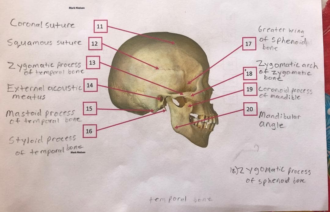 Mark Nielsen
Coronal Suture
11
Greater wing
Squamous suture
of Sphenoid
bone
12
17
Zygomatic process 13
temporal bone
Zygomatic arch
18
of zygomatic
bont
14
External acoustic
19 Coronoid process
of mandible
meatus
15
Mastoid process
of temporerl bone
20
Mandibular
angle
16
Styloid process
of temporal bone
Mark Nielsen
16)Zygomatic precess
of sphenoid bor
temporal bene
