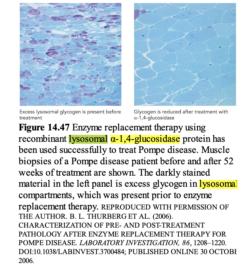 Excess lysosomal glycogen is present before
treatment
Glycogen is reduced after treatment with
a-1,4-glucosidase
Figure 14.47 Enzyme replacement therapy using
recombinant lysosomal a-1,4-glucosidase protein has
been used successfully to treat Pompe disease. Muscle
biopsies of a Pompe disease patient before and after 52
weeks of treatment are shown. The darkly stained
material in the left panel is excess glycogen in lysosomal
compartments, which was present prior to enzyme
replacement therapy. REPRODUCED WITH PERMISSION OF
THE AUTHOR. B. L. THURBERG ET AL. (2006).
CHARACTERIZATION OF PRE- AND POST-TREATMENT
PATHOLOGY AFTER ENZYME REPLACEMENT THERAPY FOR
POMPE DISEASE. LABORATORY INVESTIGATION, 86, 1208-1220.
DOI:10.1038/LABINVEST.3700484; PUBLISHED ONLINE 30 OCTOBE
2006.