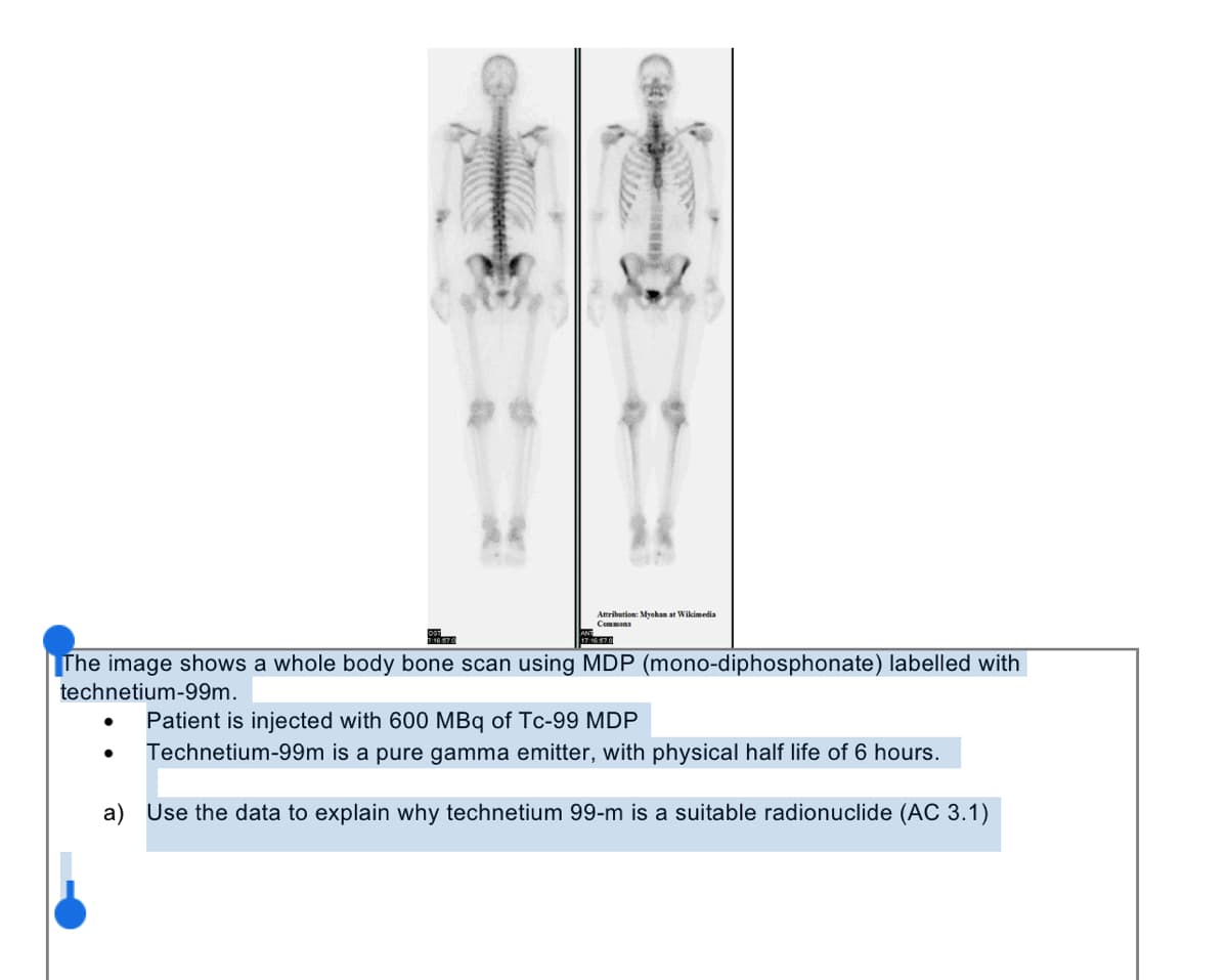 Attribution: Mychan at Wikimedia
Commons
17.16.67.0
The image shows a whole body bone scan using MDP (mono-diphosphonate) labelled with
technetium-99m.
Patient is injected with 600 MBq of Tc-99 MDP
●
Technetium-99m is a pure gamma emitter, with physical half life of 6 hours.
a) Use the data to explain why technetium 99-m is a suitable radionuclide (AC 3.1)