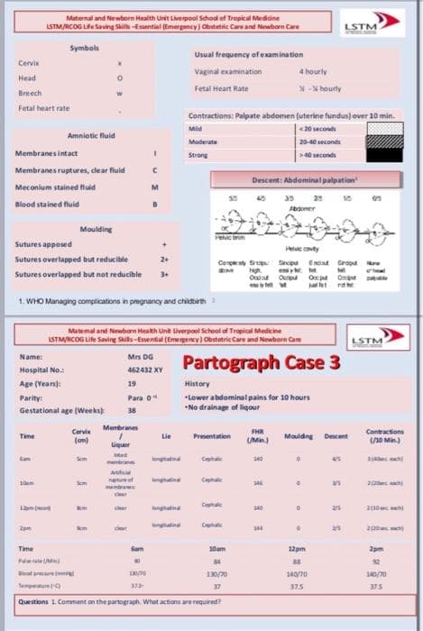 Maternal and Newborn Health Unit Liverpool School of Tropical Mediine
LSTM/RCOG Lie Saving Skilh -Eential (Emergency) Obstetic Care and Niewborn Care
LSTM
Symbols
Usual frequency of examina tion
Cervix
Vaginal examination
4 hourly
Head
X - X hourly
Fetal Heart Rate
Breech
Fetal heart rate
Contractions: Palpate abdomen (uterine fundus)over 10 min.
«20 seconds
Mild
Amniotic fluid
Maderate
20-40 seconds
Membranes intact
Strong
>40 seconds
Membranes ruptures, clear fluid
Descent: Abdominalpalpation
Meconium stained fluid
M
45 35
2
Biood stained fluid
Abdomer
Moulding
Sutures apposed
Helve covty
Sutures overlapped but reducible
2+
Conpety Sp Sincipa Encixt Groput re
M Ng y
Sutures overlapped but not reducible
Ocuut Ou Ox O
jae ra
1. WHO Managing compications in pregnancy and chidbirm 1
Matemal and Newban Health Unit iverpool School of Tropical Medicine
LSTM/RCOG Life Saving Skils-Easential (Emergency) Obstetric Care and Newborn Cam
LSTM
Name:
Mrs DG
Partograph Case 3
Hospital No.:
462432 XY
Age (Vears):
19
History
"Lower abdominalpains for 10 hours
*No drainage of liqour
Parity:
Para 0"
Gestational age (Weeks)
38
Membranes
Cervie
(om)
FHR
Contractions
Time
Lie
Presentation
Mouldng
Descent
(UMin)
10 Min.)
Uquer
am
Som
ngatnd
C
S40
Aicia
C
netuof
wwbra
ongtatina
am
Sem
Cee
car
ngtati
dina
clar
Time
fam
10am
12pm
2pm
teM
84
88
92
d pem
130/70
140/70
TempareC
37
37.5
375
Questions 1. Comment an the partograph. What actions are required?

