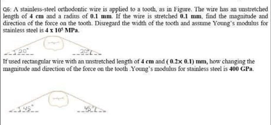 Q6: A stainless-steel orthodontic wire is applied to a tooth, as in Figure. The wire has an unstretched
length of 4 cm and a radius of 0.1 mm. If the wire is stretched 0.1 mm, find the magnitude and
direction of the force on the tooth. Disregard the width of the tooth and assume Young's modulus for
stainless steel is 4 x 10 MPa.
If used rectangular wire with an unstretched length of 4 cm and ( 0.2x 0.1) mm, how changing the
magnitude and direction of the force on the tooth .Young's modulus for stainless steel is 400 GPa.

