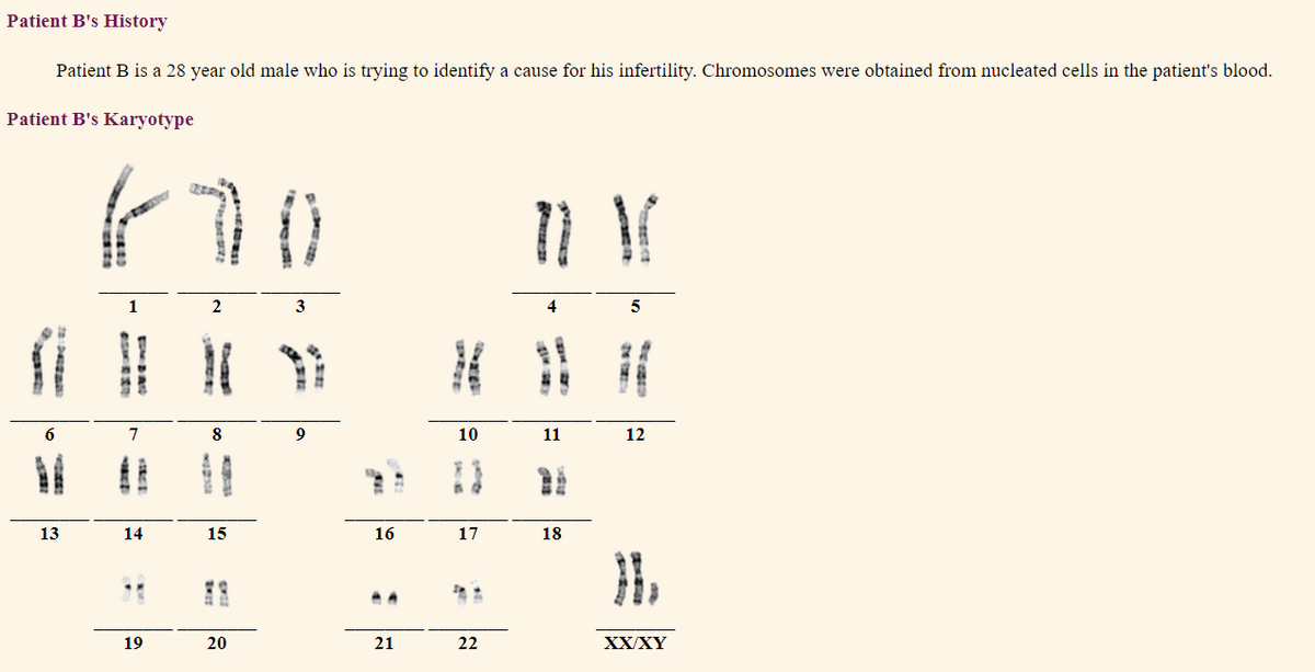 Patient B's History
Patient B is a 28 year old male who is trying to identify a cause for his infertility. Chromosomes were obtained from nucleated cells in the patient's blood.
Patient B's Karyotype
1
7
8
9
10
11
12
%3D
13
14
15
16
17
18
19
20
21
22
XX/XY
