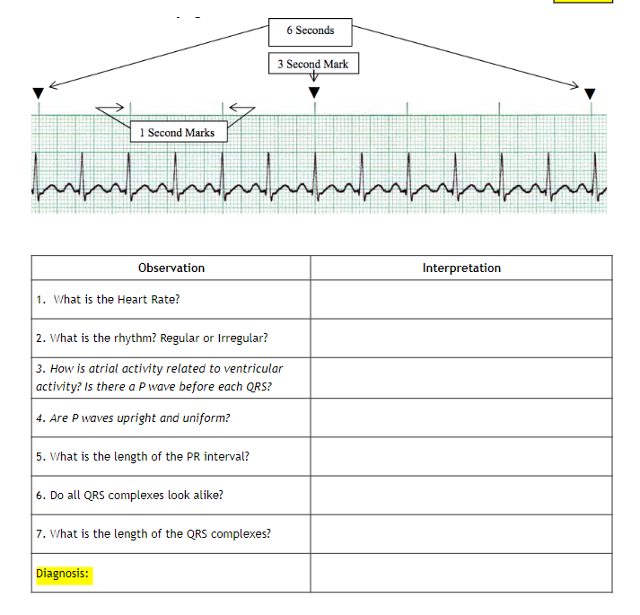 1 Second Marks
Observation
mmmmmmmmmmmm
immimi
1. What is the Heart Rate?
2. What is the rhythm? Regular or Irregular?
3. How is atrial activity related to ventricular
activity? Is there a P wave before each QRS?
4. Are P waves upright and uniform?
5. What is the length of the PR interval?
6. Do all QRS complexes look alike?
6 Seconds
3 Second Mark
7. What is the length of the QRS complexes?
Diagnosis:
Interpretation