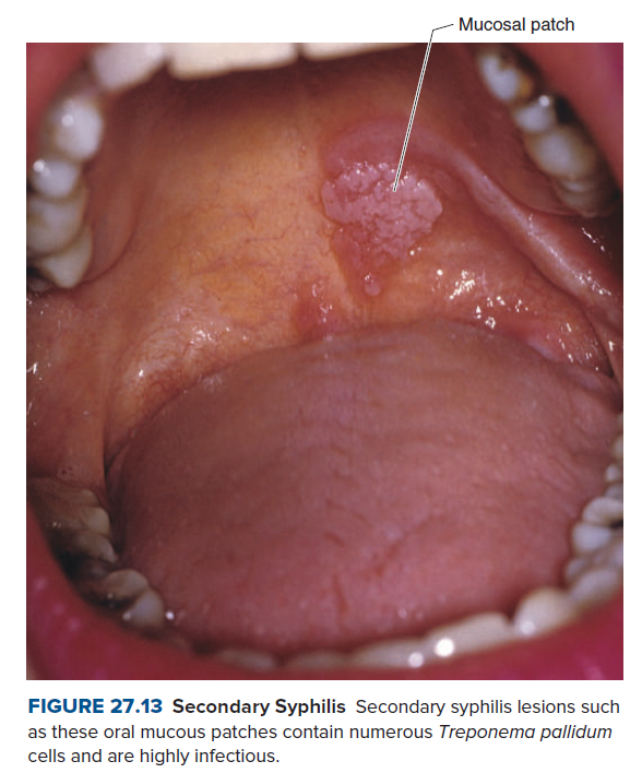 Mucosal patch
FIGURE 27.13 Secondary Syphilis Secondary syphilis lesions such
as these oral mucous patches contain numerous Treponema pallidum
cells and are highly infectious.
