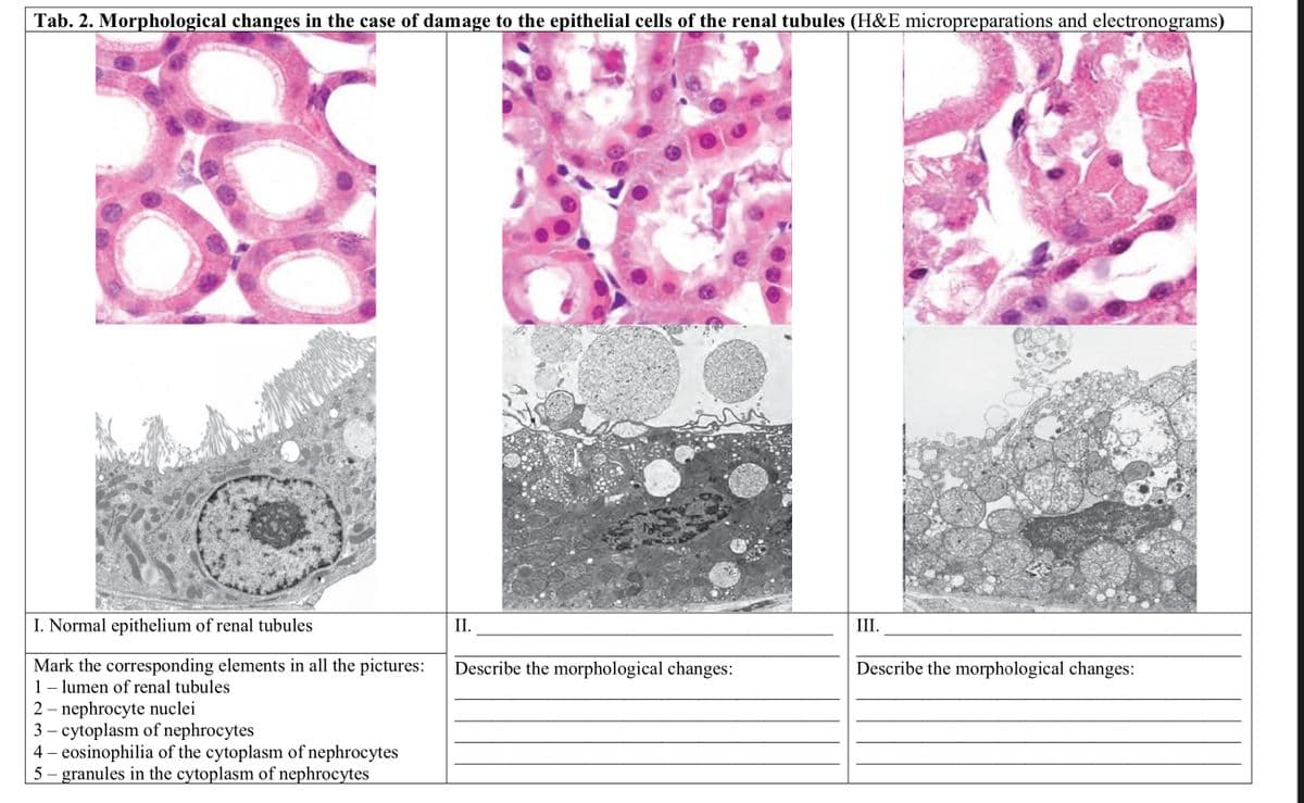 Tab. 2. Morphological changes in the case of damage to the epithelial cells of the renal tubules (H&E micropreparations and electronograms)
I. Normal epithelium of renal tubules
Mark the corresponding elements in all the pictures:
1 - lumen of renal tubules
2 - nephrocyte nuclei
3- cytoplasm of nephrocytes
4- eosinophilia of the cytoplasm of nephrocytes
5- granules in the cytoplasm of nephrocytes
II.
Describe the morphological changes:
III.
Describe the morphological changes: