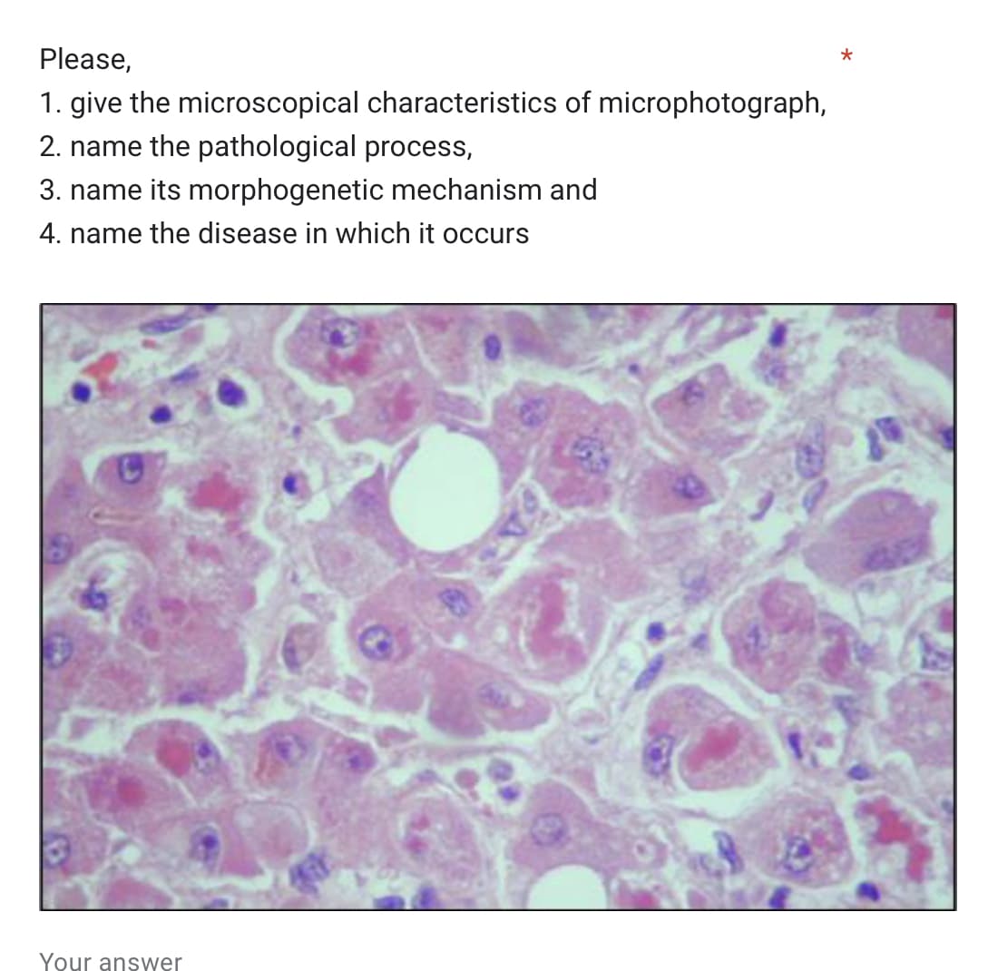 Please,
1. give the microscopical characteristics of microphotograph,
2. name the pathological process,
3. name its morphogenetic mechanism and
4. name the disease in which it occurs
Your answer