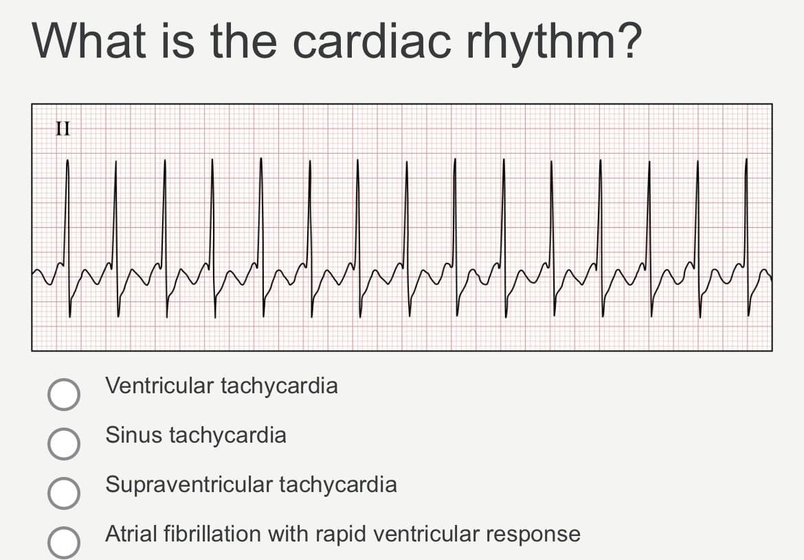 What is the cardiac rhythm?
II
wwwwwwwwwwww
Ventricular tachycardia
Sinus tachycardia
Supraventricular tachycardia
Atrial fibrillation with rapid ventricular response