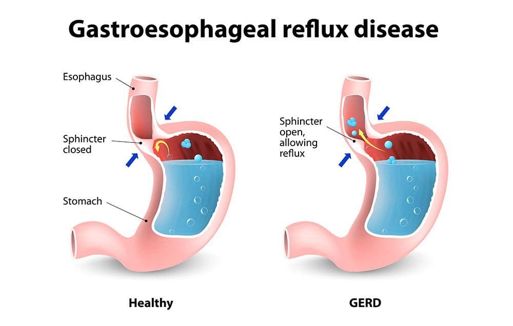 Gastroesophageal reflux disease
Esophagus
Sphincter
closed
Stomach
Healthy
Sphincter
open,
allowing
reflux
GERD