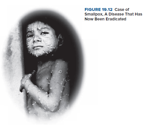 FIGURE 19.12 Case of
Smallpox, A DIsease That Has
Now Been Eradicated
