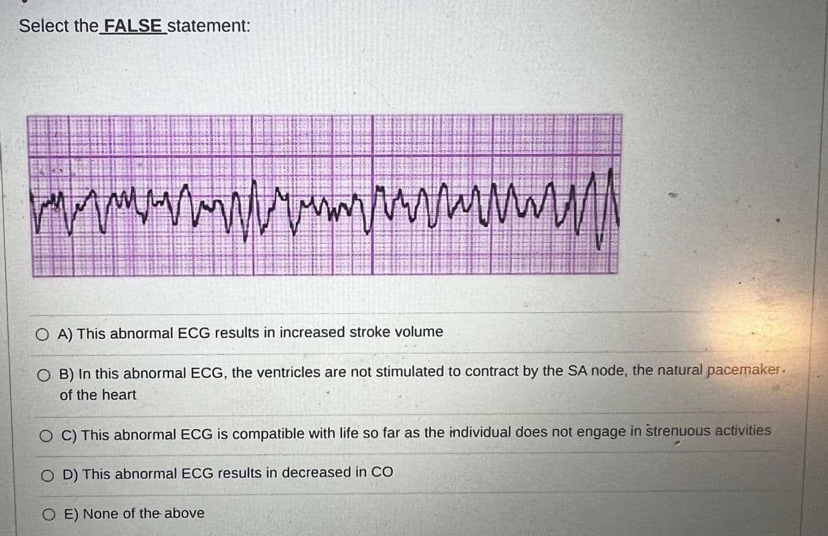 Select the FALSE statement:
/////////////////www.
OA) This abnormal ECG results in increased stroke volume
O B) In this abnormal ECG, the ventricles are not stimulated to contract by the SA node, the natural pacemaker.
of the heart
O C) This abnormal ECG is compatible with life so far as the individual does not engage in strenuous activities
OD) This abnormal ECG results in decreased in CO
OE) None of the above