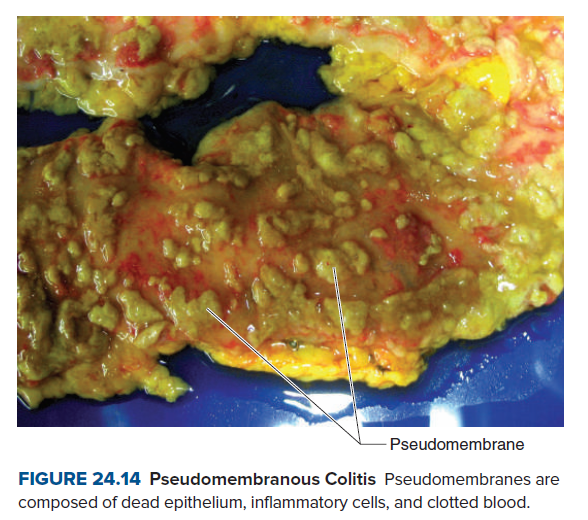 Pseudomembrane
FIGURE 24.14 Pseudomembranous Colitis Pseudomembranes are
composed of dead epithelium, inflammatory cells, and clotted blood.
