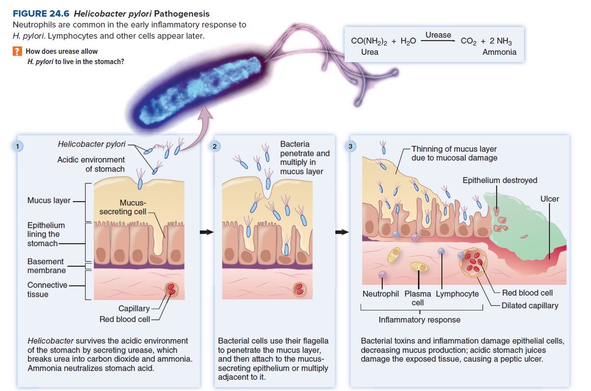 FIGURE 24.6 Helicobacter pylori Pathogenesis
Neutrophils are common in the early inflammatory response to
H. pylori. Lymphocytes and other cells appear later.
Urease
CO(NH2)2 + H,0
CO2 + 2 NH3
How does urease allow
Urea
Ammonia
H. pylori to live in the stomach?
Helicobacter pylori
Bacteria
2
Thinning of mucus layer
due to mucosal damage
Acidic environment
of stomach
penetrate and
multiply in
mucus layer
Epithelium destroyed
Mucus layer
Mucus-
Ulcer
secreting cell
mar
Epithelium
lining the
stomach
Basement
membrane
Connective
Red blood cell
Neutrophil Plasma Lymphocyte
cell
tissue
Dilated capillary
Capillary-
Red blood cell-
Inflammatory response
Bacterial cells use their flagella
to penetrate the mucus layer,
and then attach to the mucus-
secreting epithelium or multiply
adjacent to it.
Helicobacter survives the acidic environment
of the stomach by secreting urease, which
breaks urea into carbon dioxide and ammonia.
Bacterial toxins and inflammation damage epithelial cells,
decreasing mucus production; acidic stomach juices
damage the exposed tissue, causing a peptic ulcer.
Ammonia neutralizes stomach acid.
