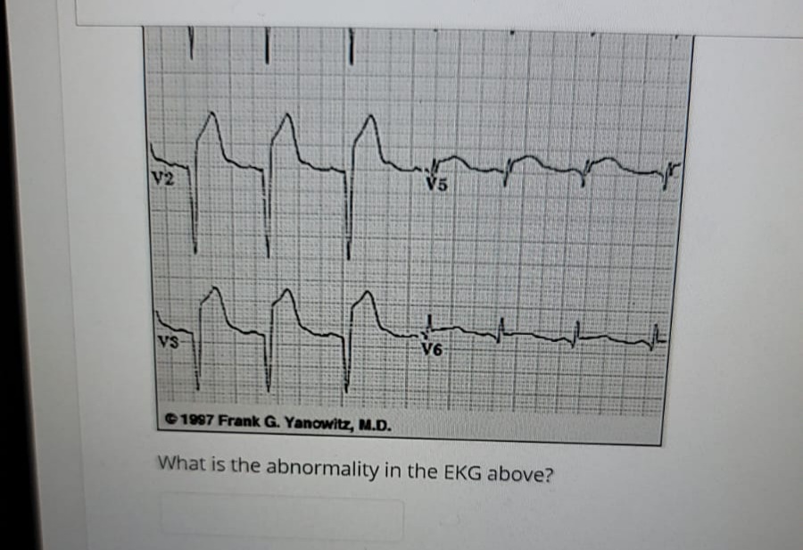 V2
V5
VS
V6
1997 Frank G. Yanowitz, M.D.
What is the abnormality in the EKG above?
